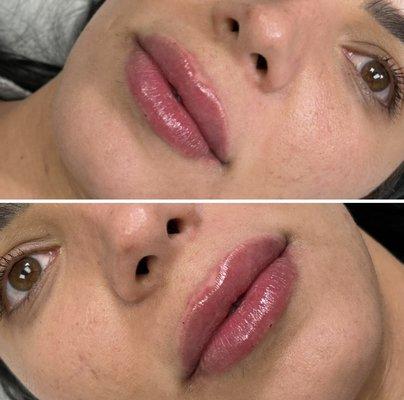 Lips Fillers- Natural Enhancement