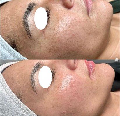 Chemical Peel Facial