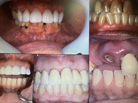 This is what can happen when you don't Take care of your mouth/teeth!  YUCK