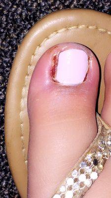 This is my toe after 2 days!!!