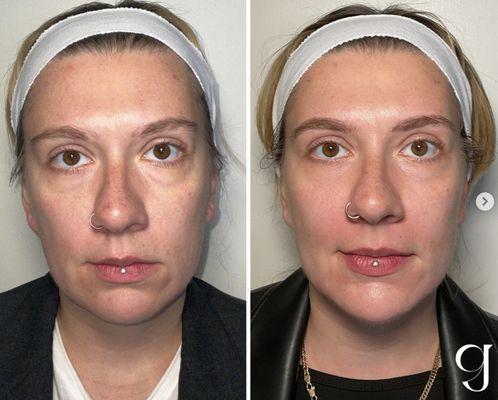 Before and after injecting HA filler in her cheeks, under eyes, chin, and jawline. Her face is more balanced and she looks well rested.