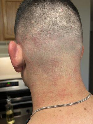 After hair cut had burns and bumps