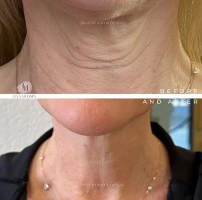 PDO Threads neck lift