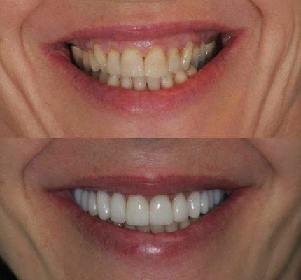 Veneers before and after