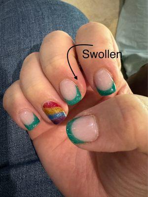 What was painted on plus swollen/infected finger