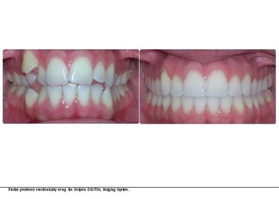 This is my finish result. Dr Horsley  (Horsley orthodontics) is the best choice I've made.