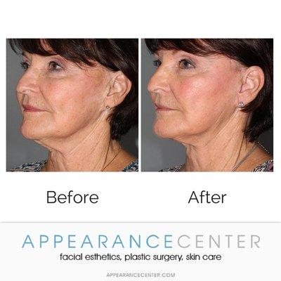 Face and Neck Lift