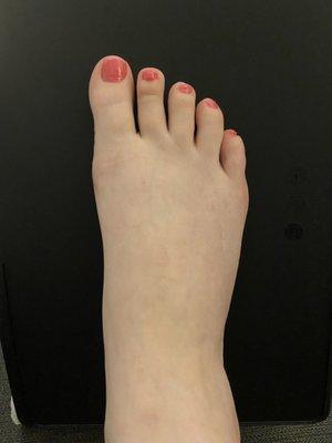 Right foot 4.5 months post-op