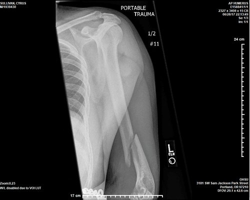 X-ray of arm broken by deputy