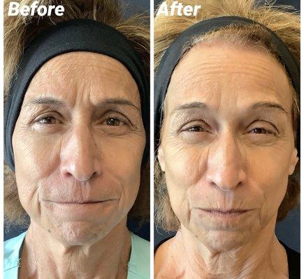 Results from Xeomin injections!