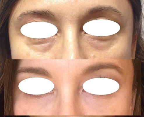 Filler to tear trough and lower eyelids