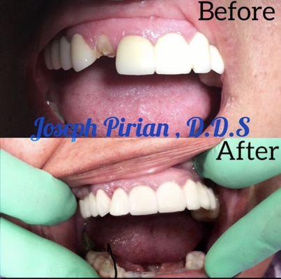 Restoration of a fractured front tooth at perfect tooth color, form and function with minimal preparation.