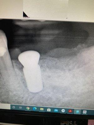 Dental Implant