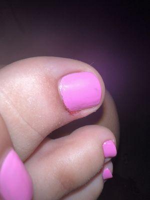 My poor ugly toe :(