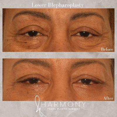 Lower blepharoplasty or lower eyelid lift addresses rid of bags, extra skin, and darkness