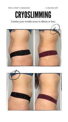 Cryoslimming Results