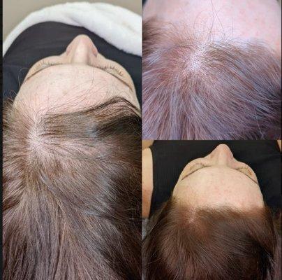 Scalp Micropigmentation Before and Afetr