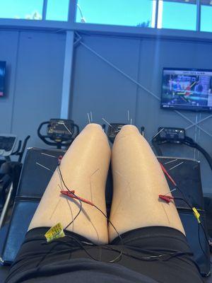 Dry needling to relive the tight facia compressing nerves, and day to day pains