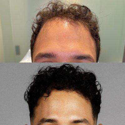 Hair Restoration