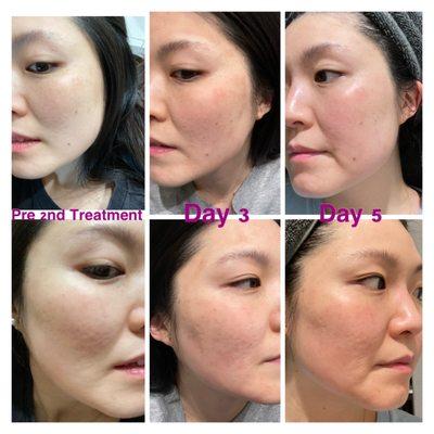 2nd Treatment Progression- Compared to my first totally different.