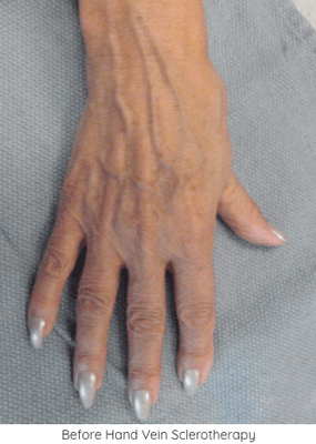 Before Hand Vein Treatment