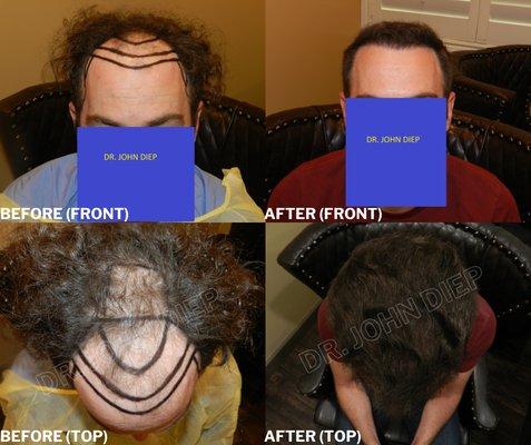 MENS ADVANCED HAIR LOSS TREATMENT