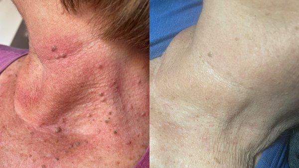 Skin Classic - Before and 1 month after treating hyperkeratosis