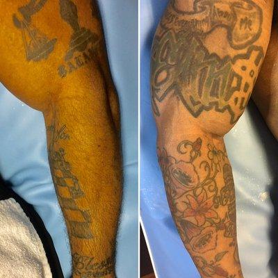 Before and after sugaring of the arm