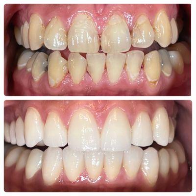 Full mouth veneers/crowns. Patient had excessive decay throughout.