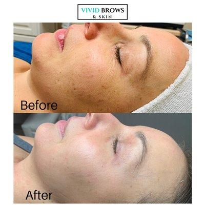 After 1 EB Skin Renewal Peel