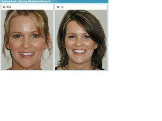 Invisalign Combined with Restorative Treatment