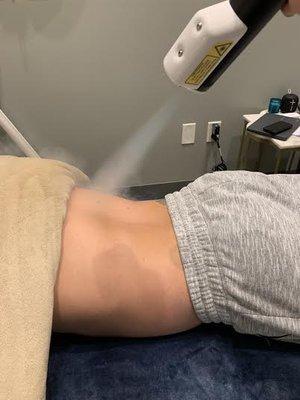 Local Cryotherapy for Back Pain