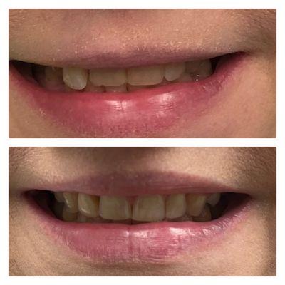 Patient came in with loose front tooth that was protruding. 
 Through Invisalign, we were able to intrude her tooth and correct their bite.