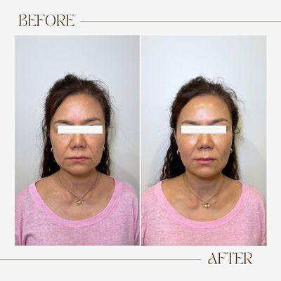 Shurink HIFU treatment Before and After. Perfect for jowling, skin laxity and sagging around jawline.