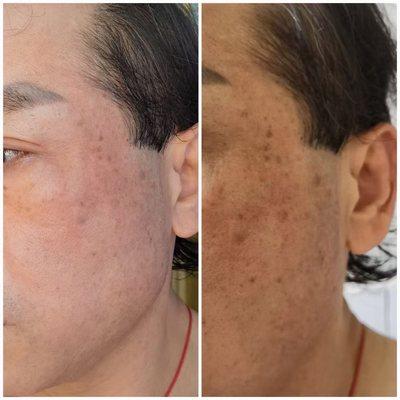 Aging spot removal