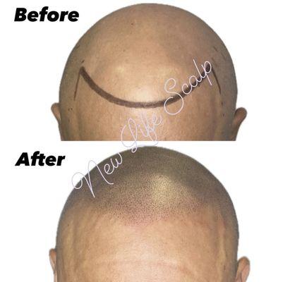 Before and after scalp micropigmentation result at new life scalp.