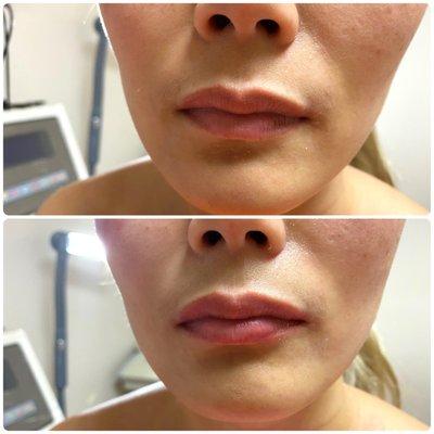 Our client is seeing smoother nasolabial folds, brighter skin, and more elasticity (upper lip has been lifted) with RF + PDRN Microneedling