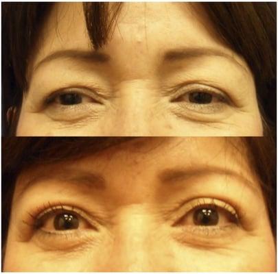 Upper blepharoplasty