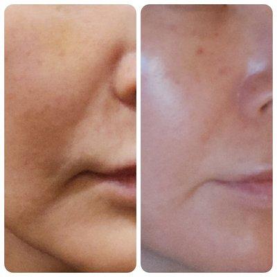 #Hydro facial and #rejuvenation