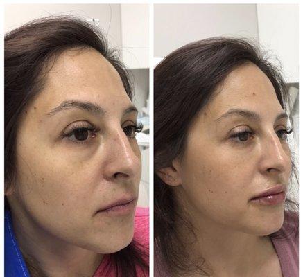 Under eye and lip filler