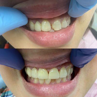 Cosmetic bridge and veneers to restore a smile