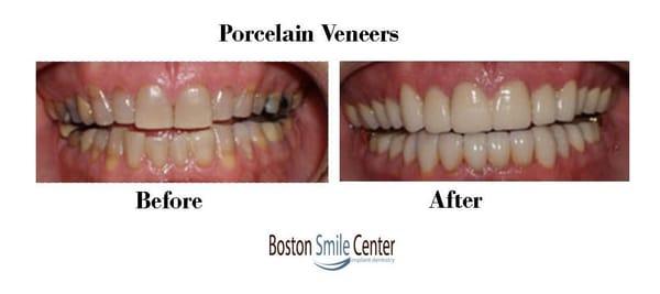 Porcelain Veneers