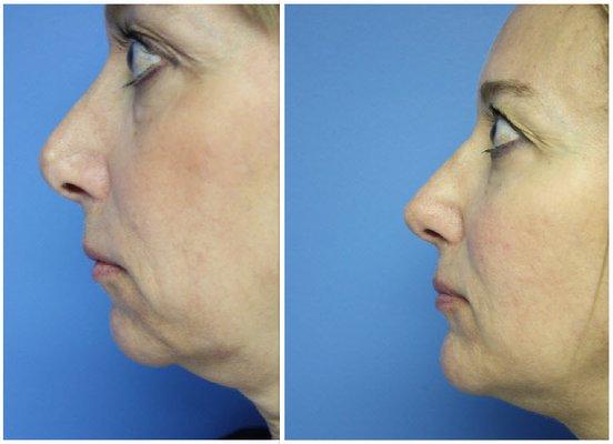 Rhinoplasty and Facelift