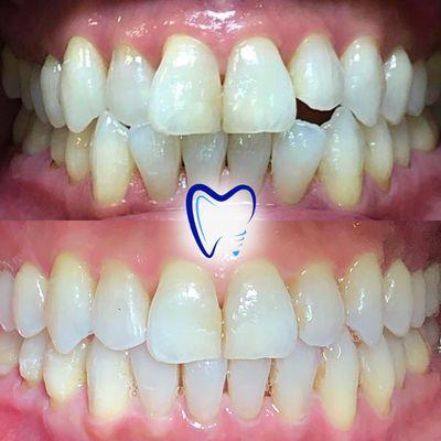 Invisalign and Teeth Whitening results here at Honda Plaza Dental