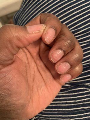 Nails are badly damaged and stripped