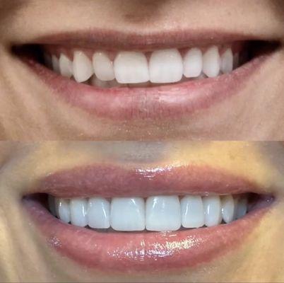 Cosmetic Veneers