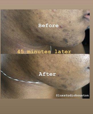 Removed dead skin, and lighten pigmentation after one deep clearing facial.