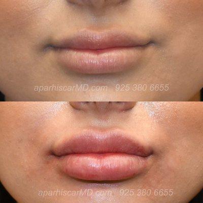 natural fuller lips