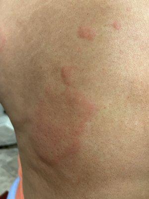 Here are hives on my body from his cosmetics. Don't trust what Rich says!