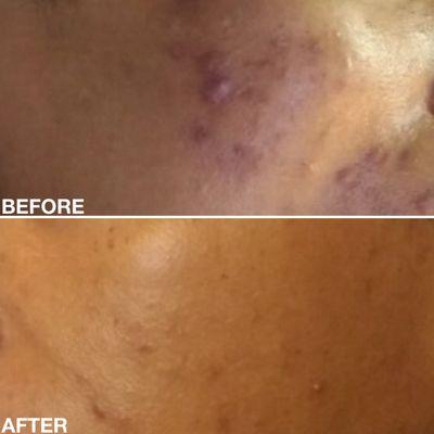 Before & After Chemical Peel Treatment